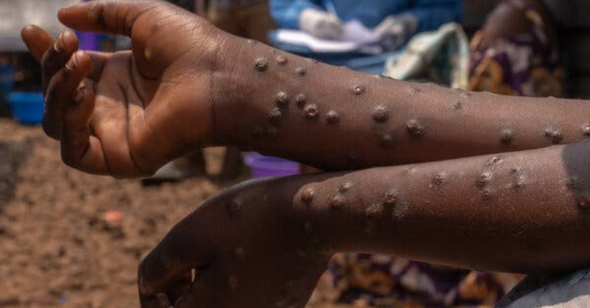Mpox Update: 72 New Cases Confirmed And One New Death