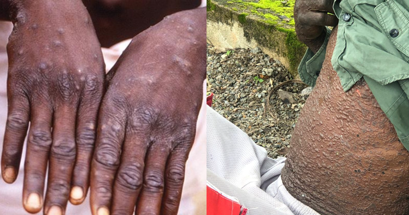 Sierra Leone Reports 32 New Mpox Cases And One New Death